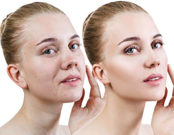 Restylane 1 毫升 Lyft HA 真皮填充剂可矫正中度至重度面部皱纹和褶皱