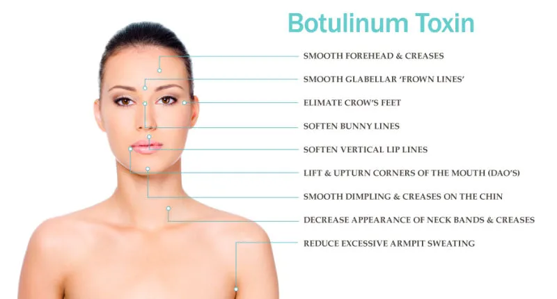 Pour l'amincissement et la lutte contre les rides Beutox Batulaxs Resty Dermal Filler Juvederms 0