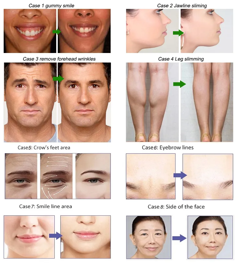 Pour l'amincissement et la lutte contre les rides Beutox Batulaxs Resty Dermal Filler Juvederms 1